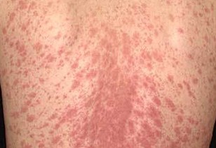 Pityriasis Rosea . Causes and pityriasis rosea treatment ...