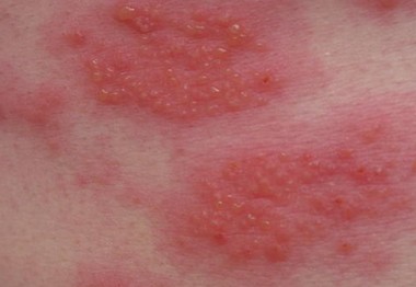 Red scaly rash - RightDiagnosis.com