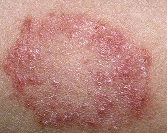 How do you Catch Ringworm? - About Pediatrics - Verywell
