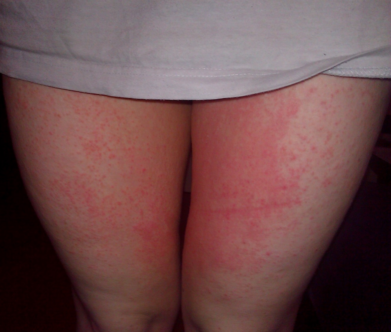 red rash on leg not itchy #10