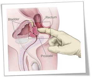 Prostatitis 4 típusa Lehet- e prostatitis egy fiatal srácban