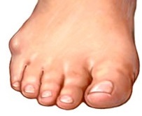 best shoes for saddle bone deformity