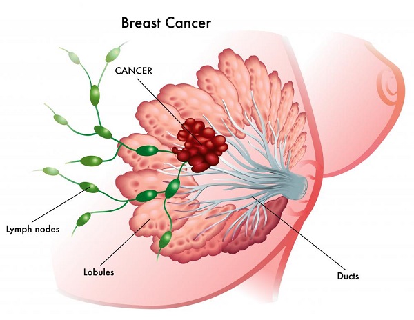 What Is Stage 3 Breast Cancer and How to Treat It? | Just ...