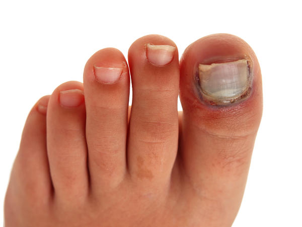 Toenail Falling Off: Know the Causes, Signs & Treatments | Just-Health.net