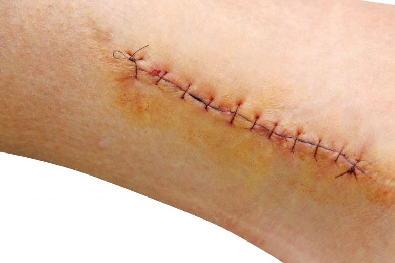 Got Stitches? Here